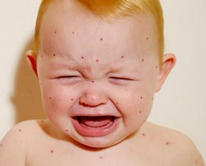 婴儿湿疹最佳治疗方法有哪些？